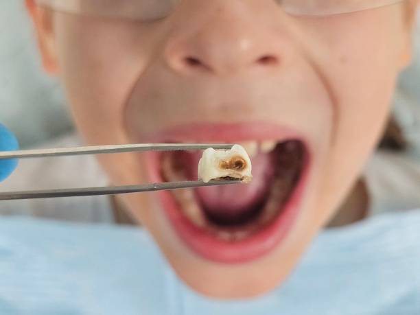 Best Emergency Dental Extractions in Genoa, IL